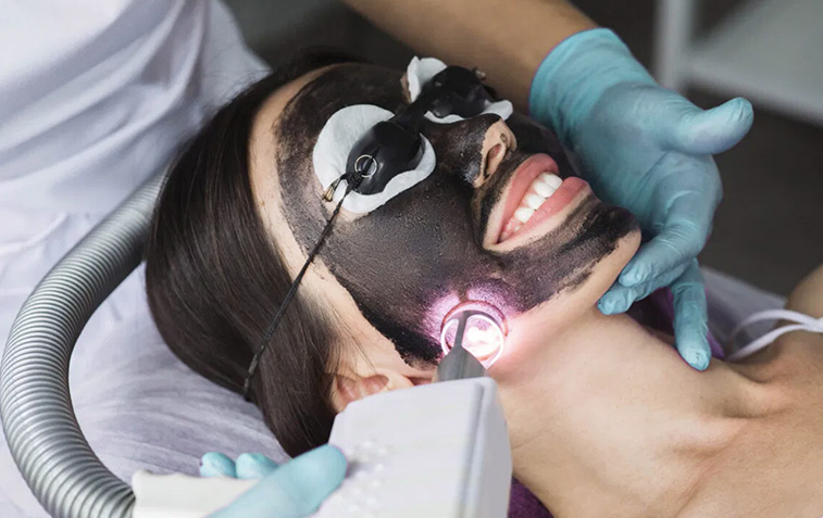 woman receiving laser carbon facial