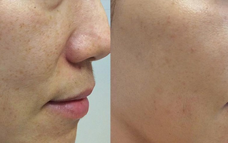 skin complexion before and after