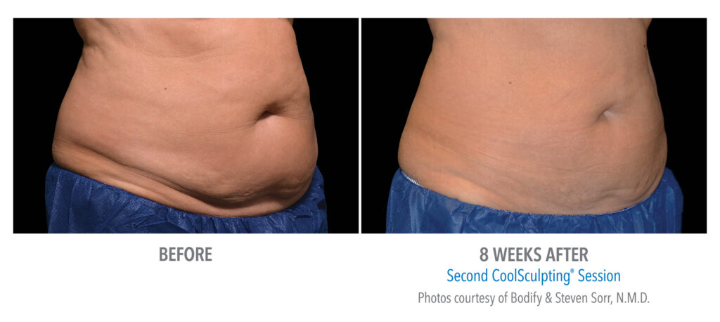 CoolSculpting before and after stomach