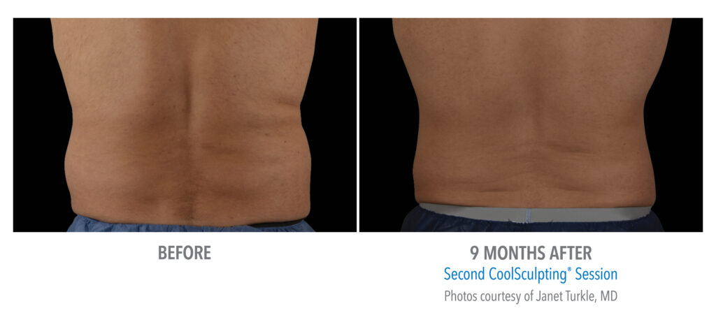 back fat coolsculpting before after