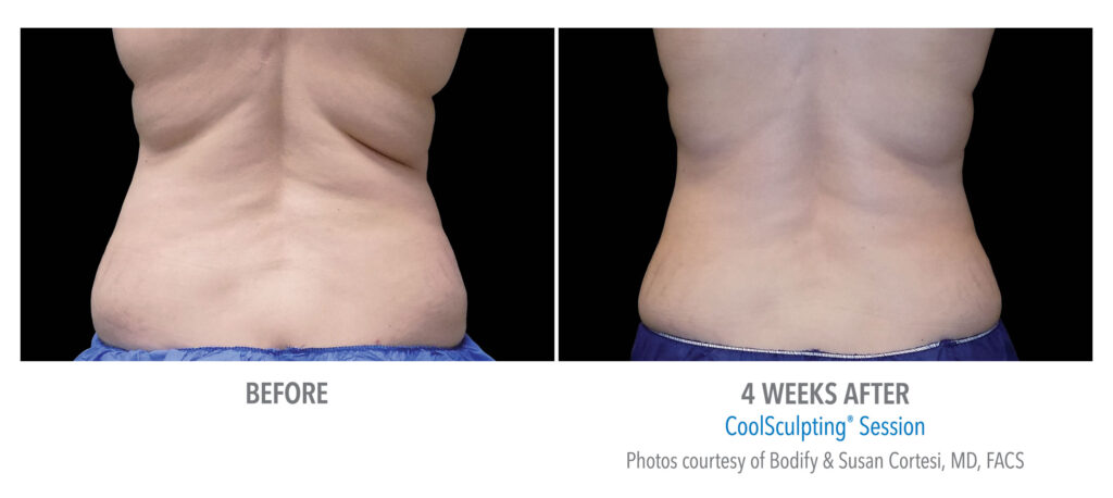 back fat coolsculpting before afters