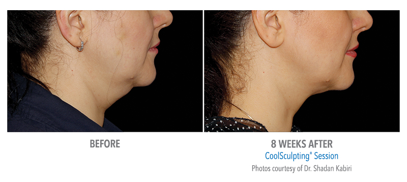 coolsculpting chin before after