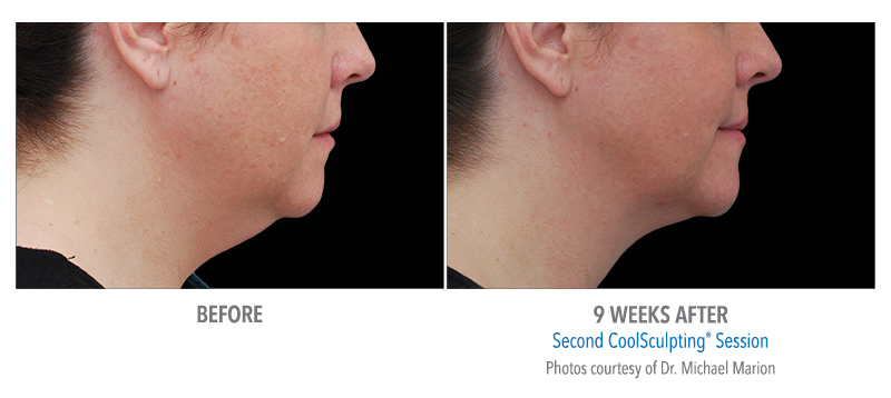 coolsculpting double chin san diego