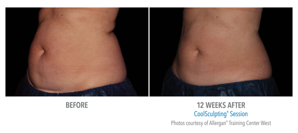 coolsculpting stomach before after