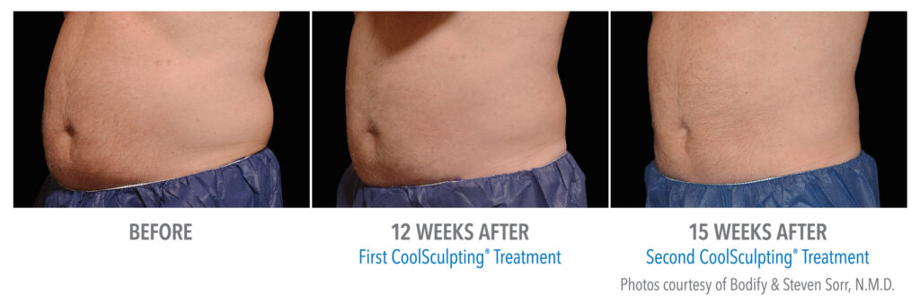coolsculpting stomach san diego