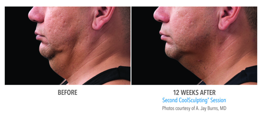 double chin coolsculpting