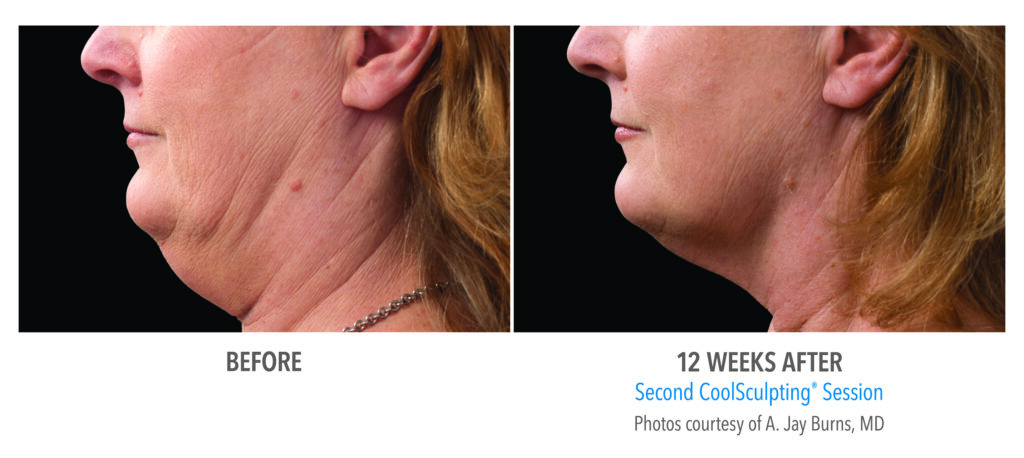 double chin coolsculpting before after