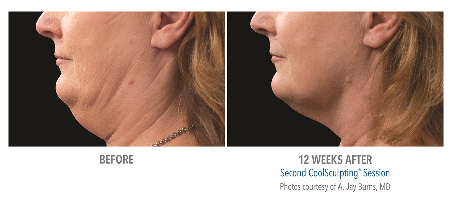 double chin coolsculpting before afters