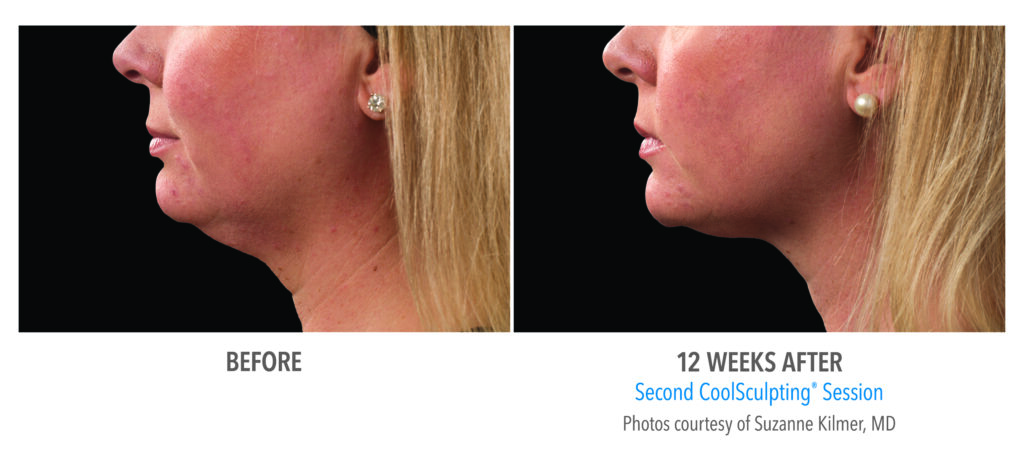 double chin fat reduction before after