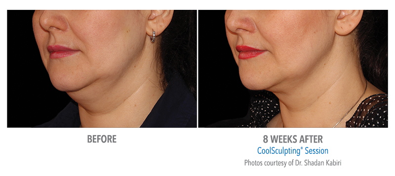 double chin reduction coolsculpting