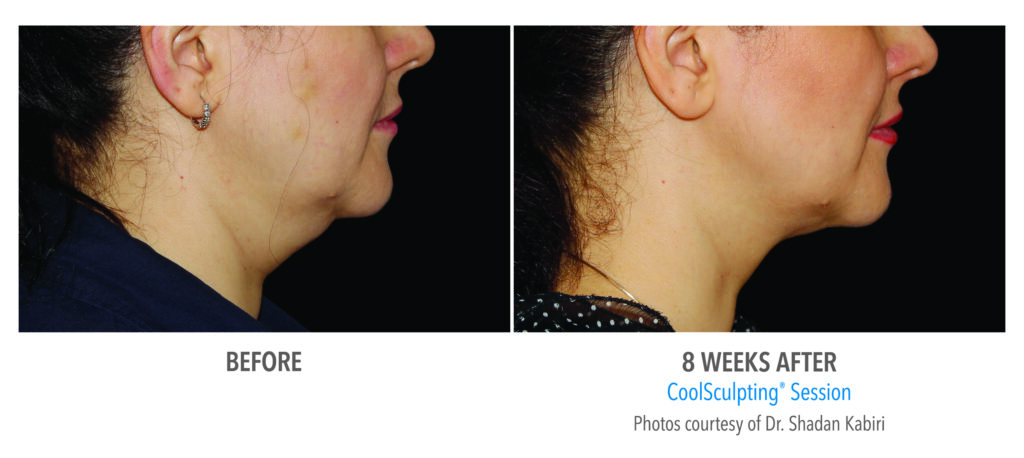 double chin removal coolsculpting