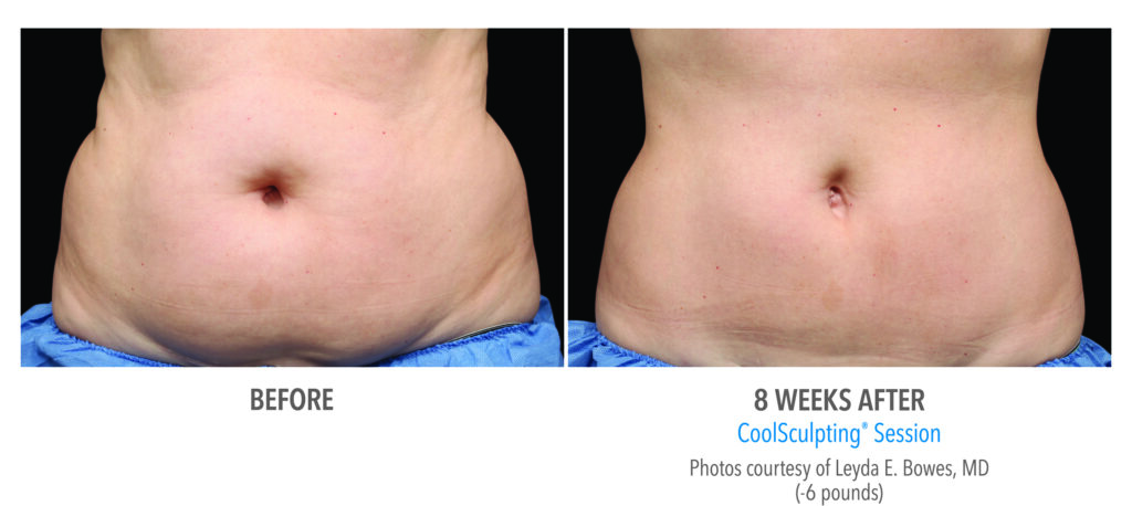 female coolsculpting before after stomach