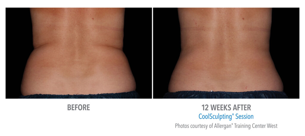 female flanks coolsculpting before after