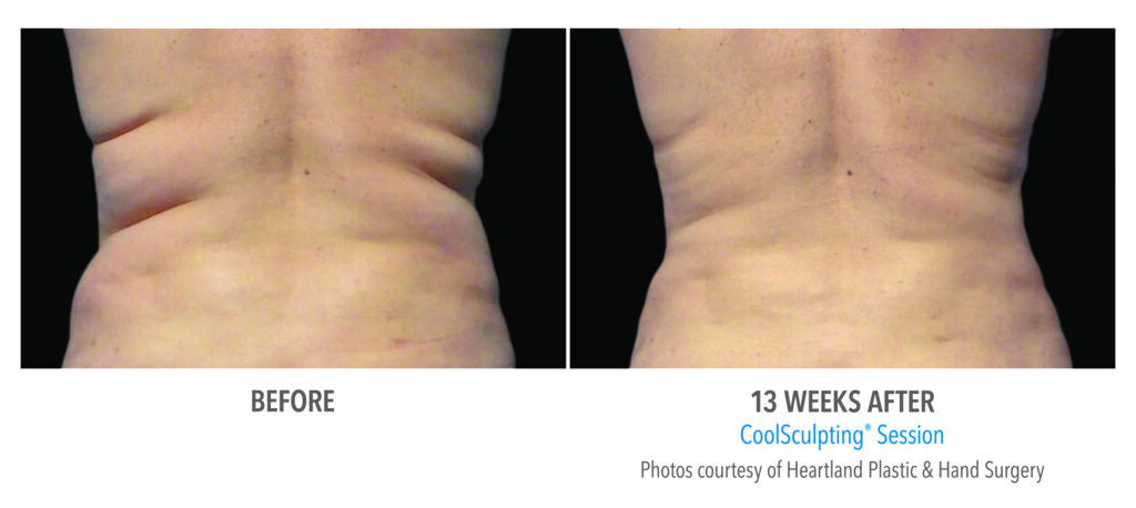 flank fat coolsculpting