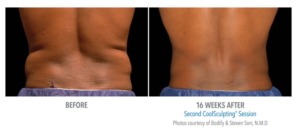 flank fat reduction before after