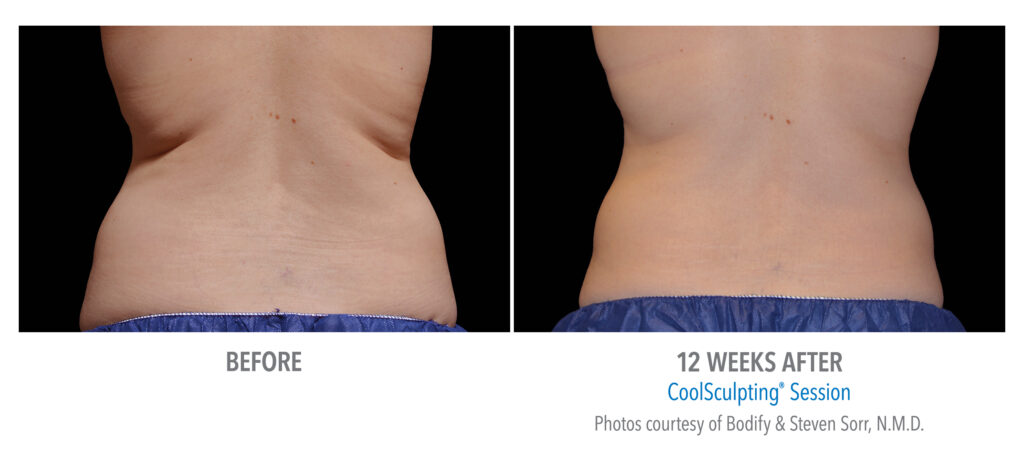 flank fat reduction with coolsculpting