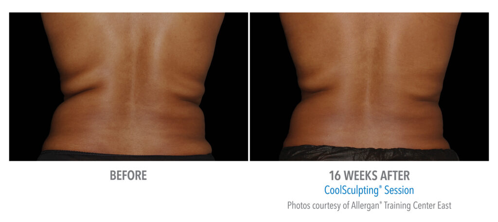 flanks coolsculpting before after
