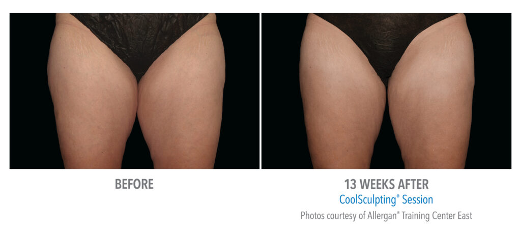 inner thigh coolsculpting before after