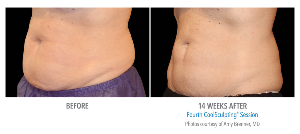 lower stomach coolsculpting