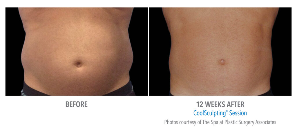 stomach coolsculpt