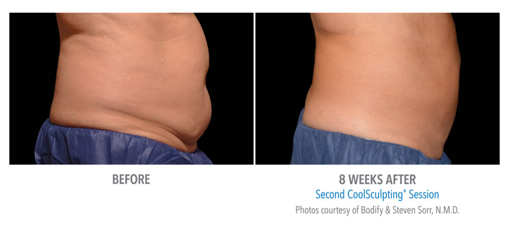 stomach coolsculpting before after