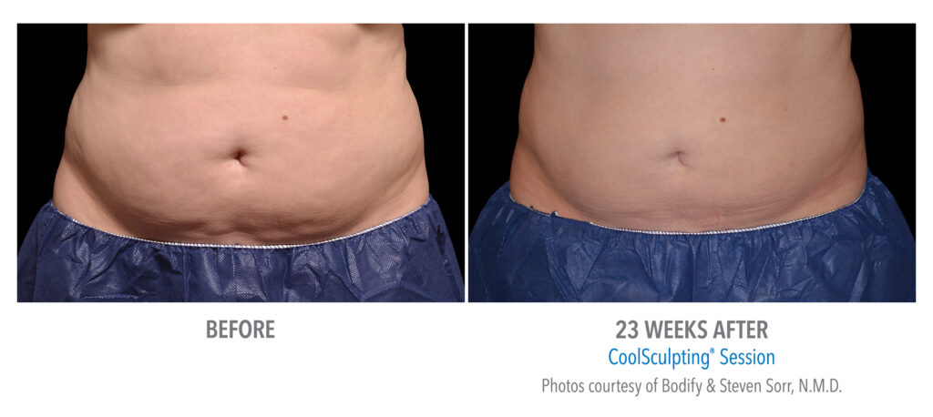 stomach coolsculpting in san diego