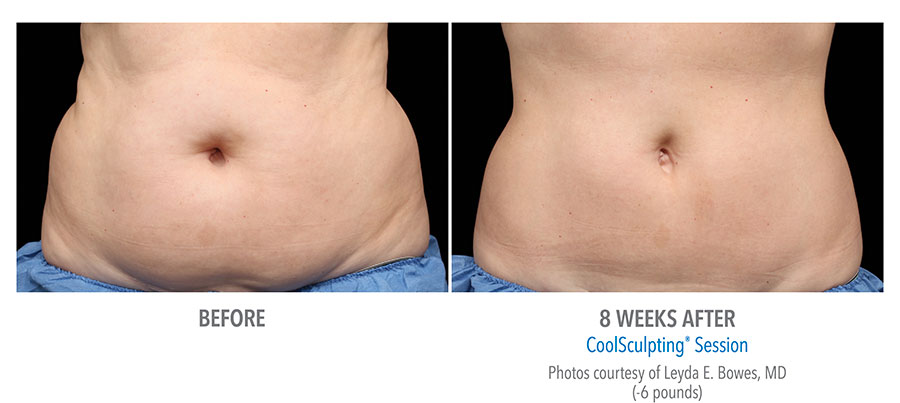stomach fat reduction coolsculpting