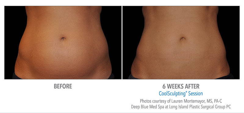 stomach flattening coolsculpting before after