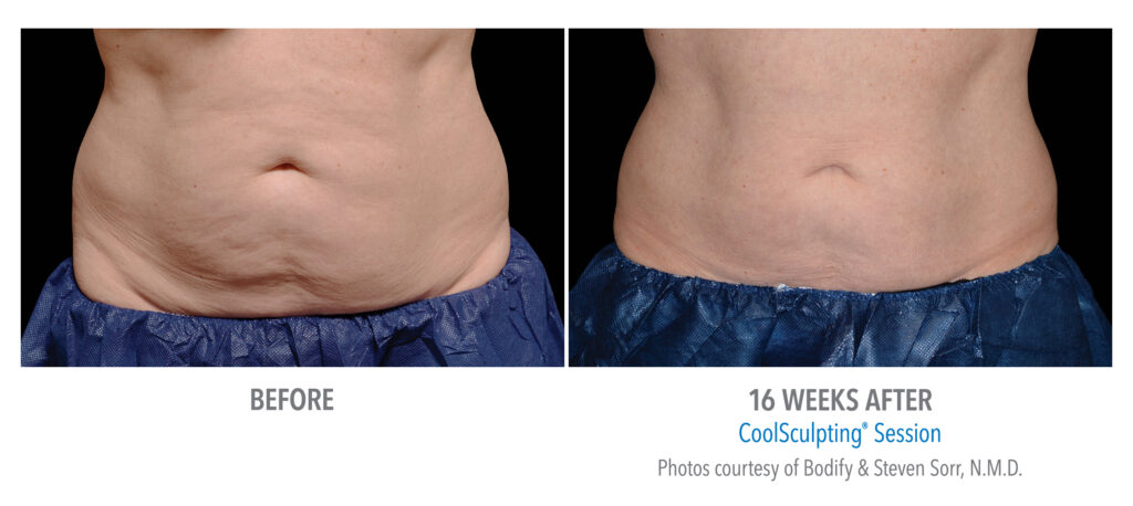 stomach flattening coolsculpting san diego