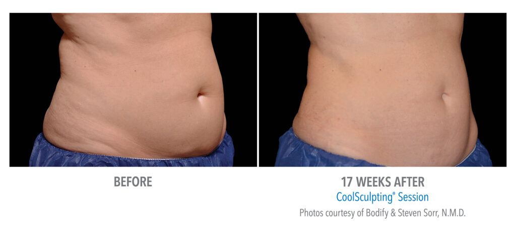 stomach flattening with coolsculpting