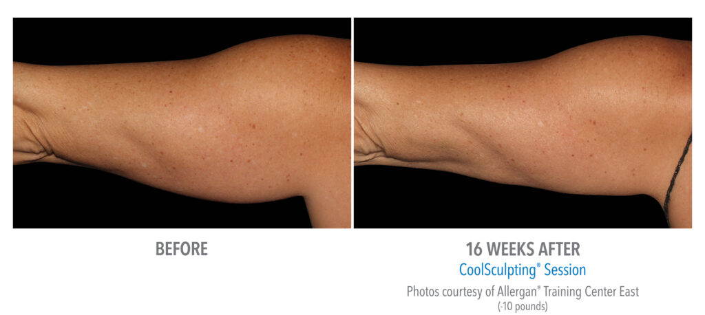 upper arm coolsculpting