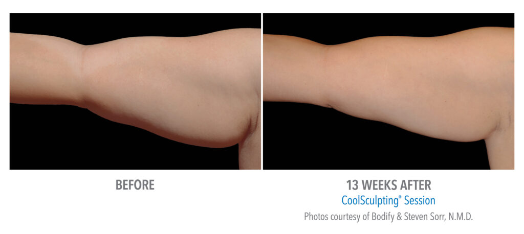 upper arm coolsculpting before after