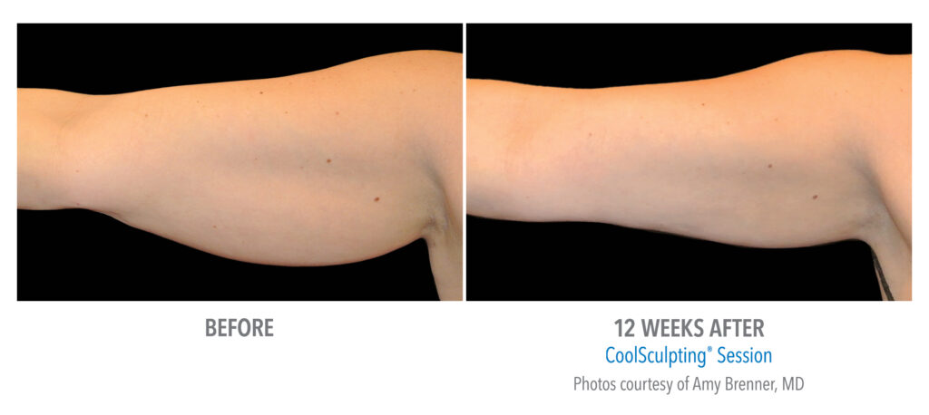 upper arm fat coolsculpting