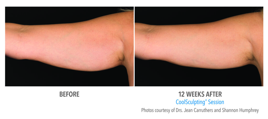 upper arm fat reduction coolsculpting