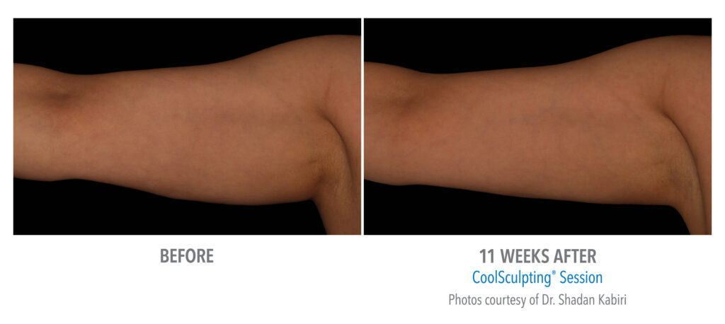 upper arm fat treatment